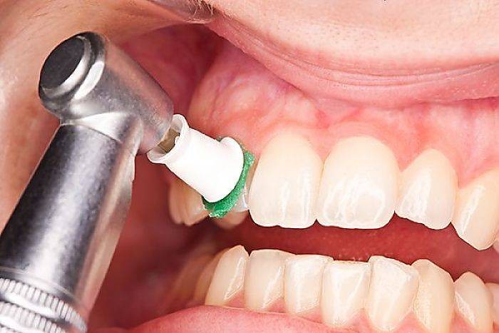 تفاوت جرم گیری و بلیچینگ