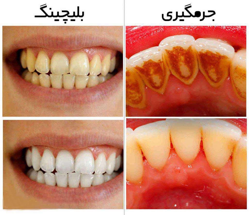 تفاوت جرم گیری و بلیچینگ