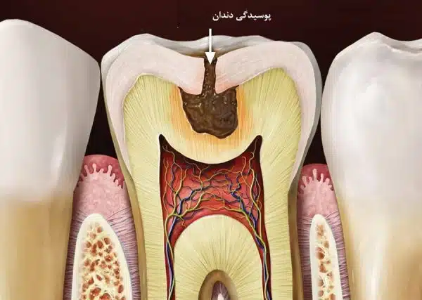 علائم پوسیدگی دندان