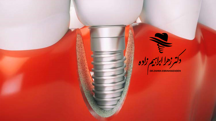 پری‌ایمپلنتایتیس چیست؟