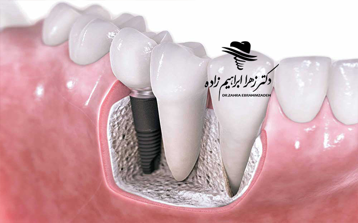 ایمپلنت کل دهان چیست؟