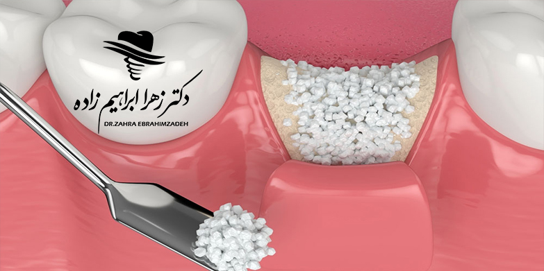 آیا می‌توان با کمبود شدید استخوان ایمپلنت کرد؟