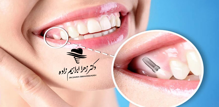 عفونت ایمپلنت