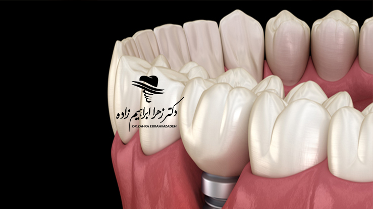 پری‌ایمپلنتایتیس چیست؟