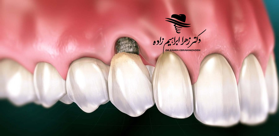 عفونت ایمپلنت