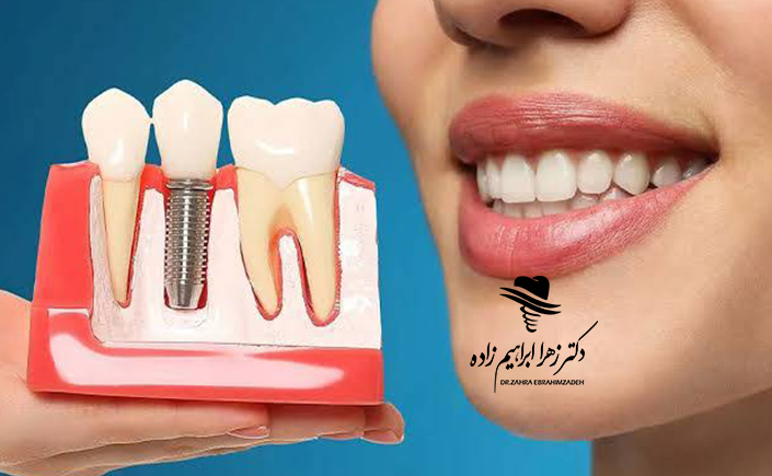 لق شدن ایمپلنت