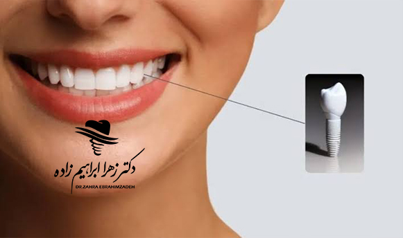 ایمپلنت فوری چیست؟