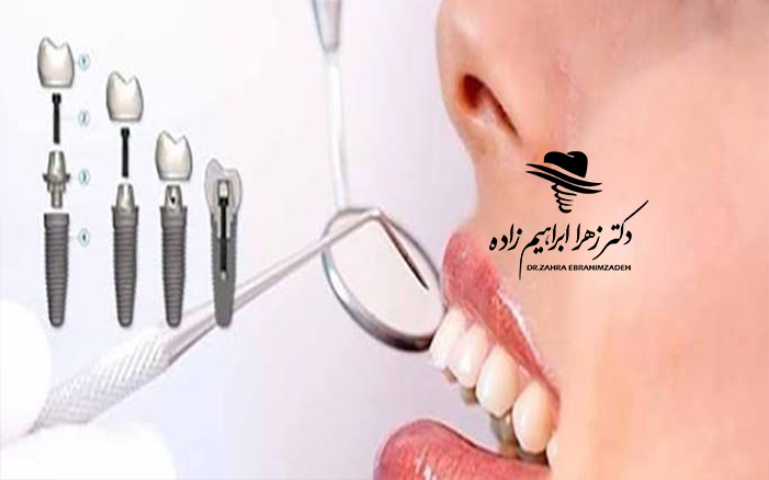 ایمپلنت کل دهان چیست؟