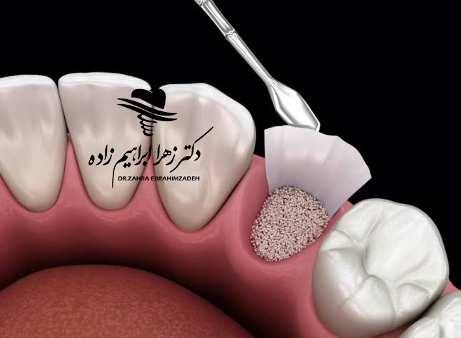 آیا می‌توان با کمبود شدید استخوان ایمپلنت کرد؟