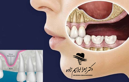سینوس لیفت چیست و چه زمانی قبل از ایمپلنت انجام می‌شود؟