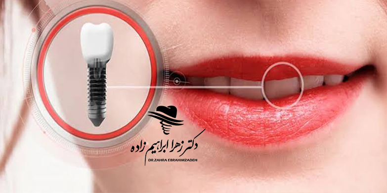 آیا می‌توان با کمبود شدید استخوان ایمپلنت کرد؟
