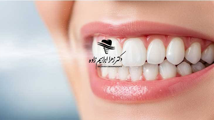 شکست ایمپلنت دندان