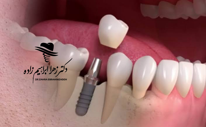 لق شدن ایمپلنت