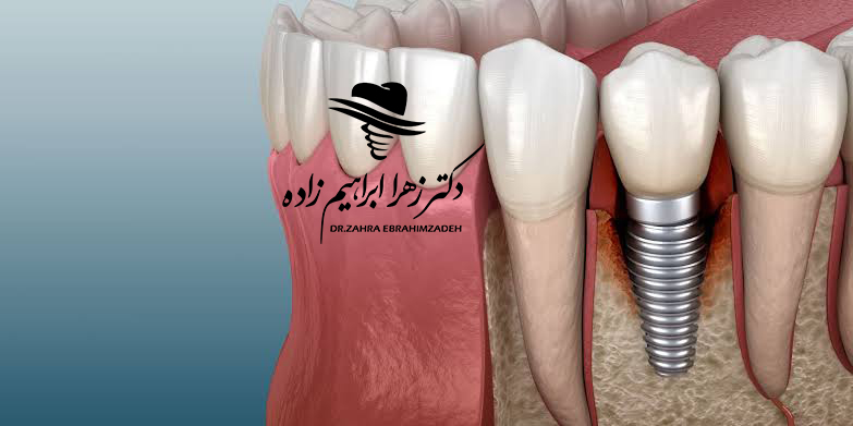 آیا می‌توان با کمبود شدید استخوان ایمپلنت کرد؟