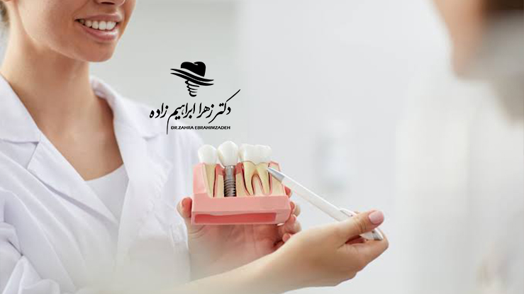علائم شکست ایمپلنت چیست؟