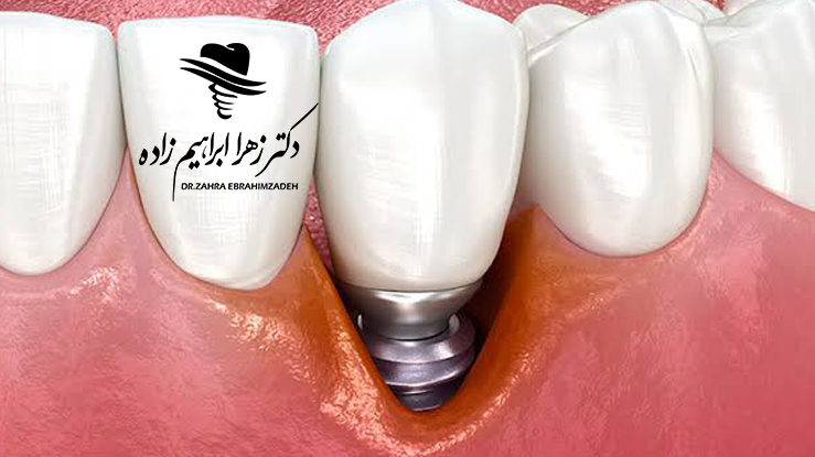 پری‌ایمپلنتایتیس چیست؟