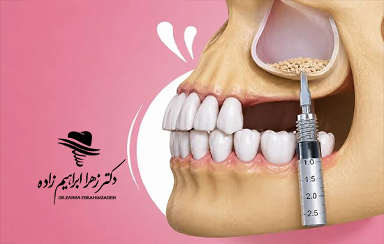 سینوس لیفت چیست و چه زمانی قبل از ایمپلنت انجام می‌شود؟