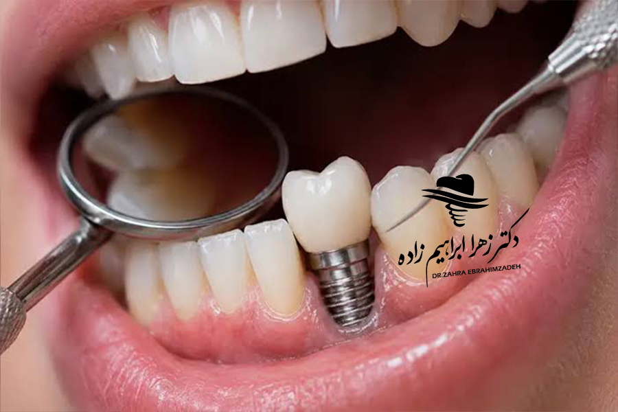 ایمپلنت همزمان با کشیدن دندان؛ آیا امکان‌پذیر است؟