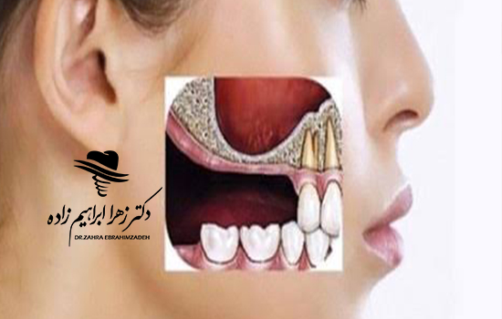 سینوس لیفت چیست و چه زمانی قبل از ایمپلنت انجام می‌شود؟