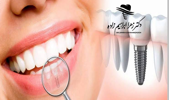 ایمپلنت فوری چیست؟