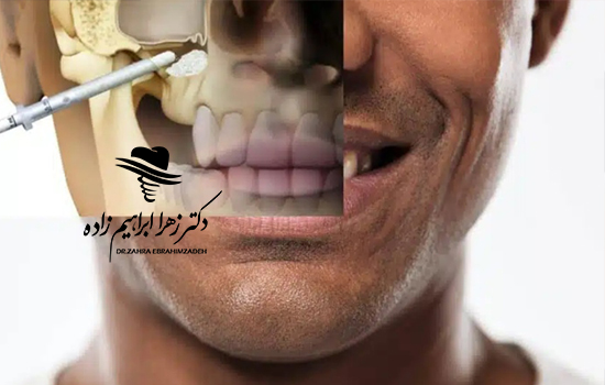 سینوس لیفت چیست و چه زمانی قبل از ایمپلنت انجام می‌شود؟