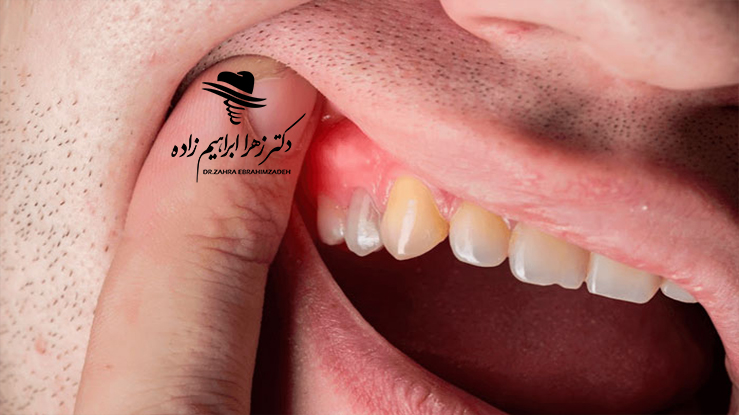پری‌ایمپلنتایتیس چیست؟
