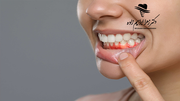 پری‌ایمپلنتایتیس چیست؟