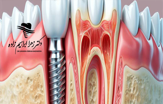 سینوس لیفت چیست و چه زمانی قبل از ایمپلنت انجام می‌شود؟
