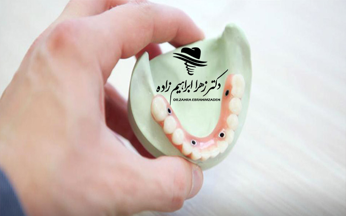 ایمپلنت کل دهان چیست؟