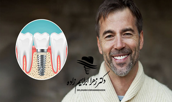 ایمپلنت فوری چیست؟